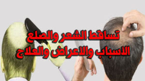 اسباب تساقط الشعر وشامبو هيمالايا علاج سقوط  الشعر.